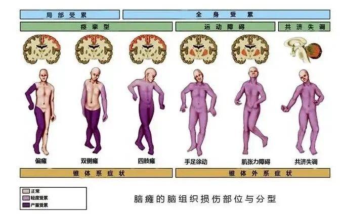 关于脑瘫的科普——分型、症状、检查手段和治疗方案,这篇文总结全了! - 知乎