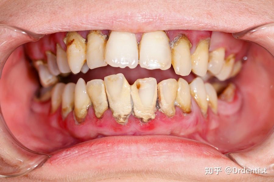 为什么每天刷牙依然有牙垢和口臭? - 知乎
