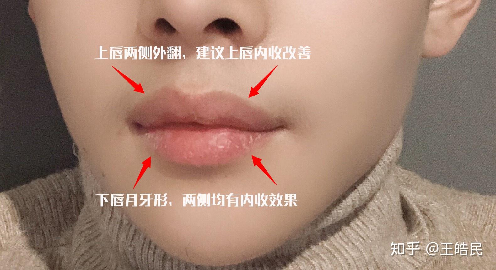 我是一个女生17岁我的上嘴唇外翻就是上嘴唇很大下嘴唇正好合适有什么