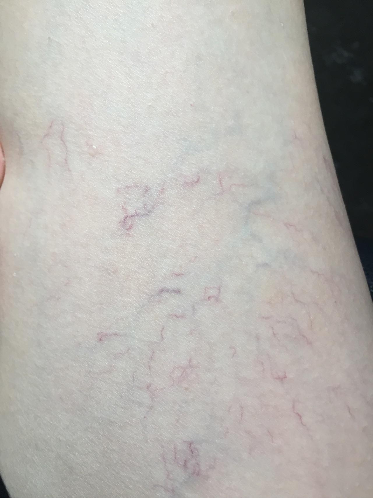 腿上静脉曲张很多红血丝怎么办? - 知乎