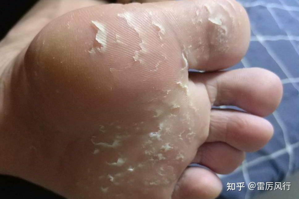 两只脚的脚底都严重脱皮怎么办? - 知乎