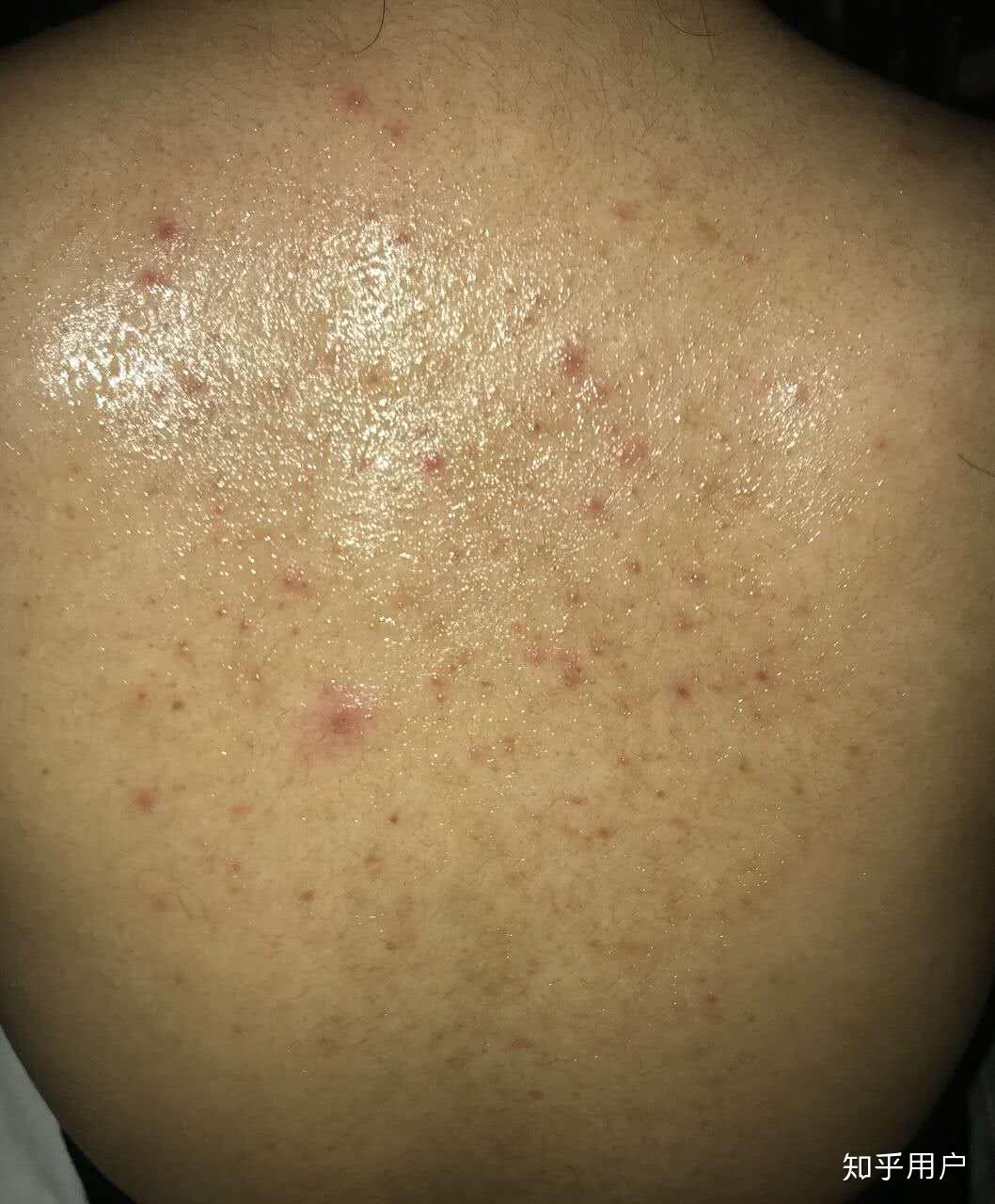 请问背部的痘痘以及痘印可以在10天之内完全祛除么需要怎么做