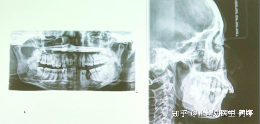 难度超5星!单侧正锁颌,严重偏颌患者,如何不拔牙,配合支抗钉完美解决! - 知乎