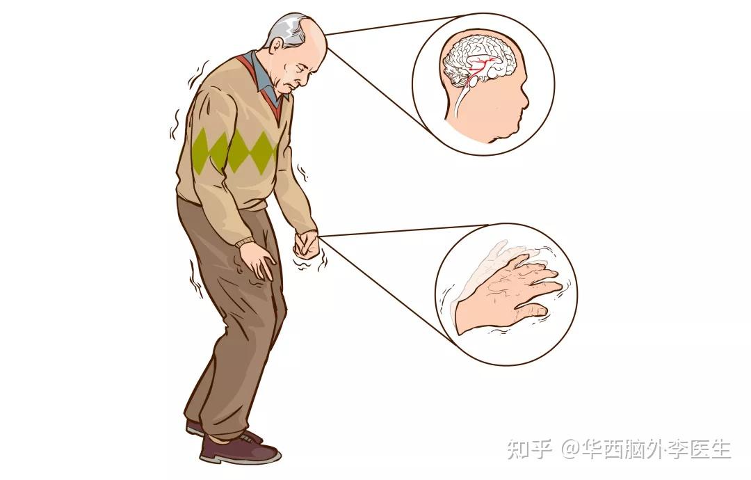帕金森病为什么会遇上异动症?该如何应对? - 知乎