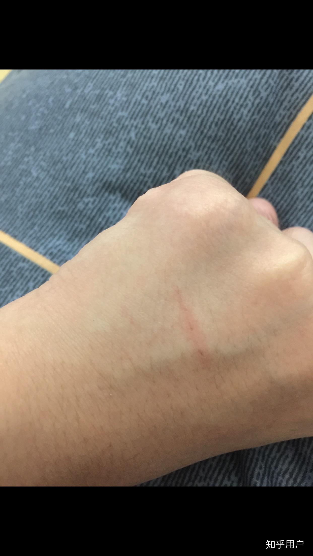 被猫咬出血了怎么办