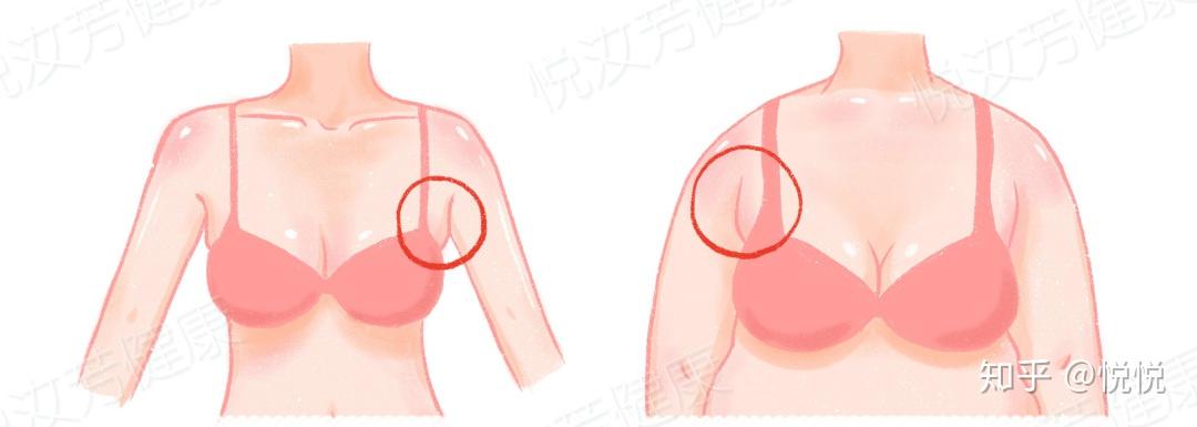 運動內衣沒有收副乳的功效會導致副乳的出現嗎