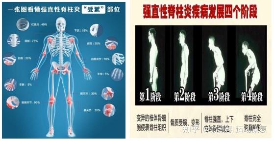 强直性脊柱炎早期有哪些预警信号?