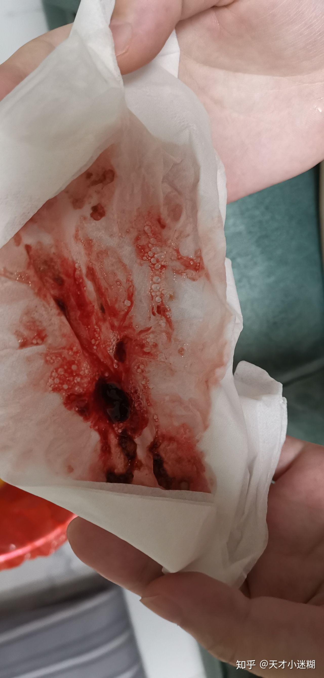 孕吐严重,不能喝水,反酸伤到消化道,吐血,大口大口地吐血,怎么办?