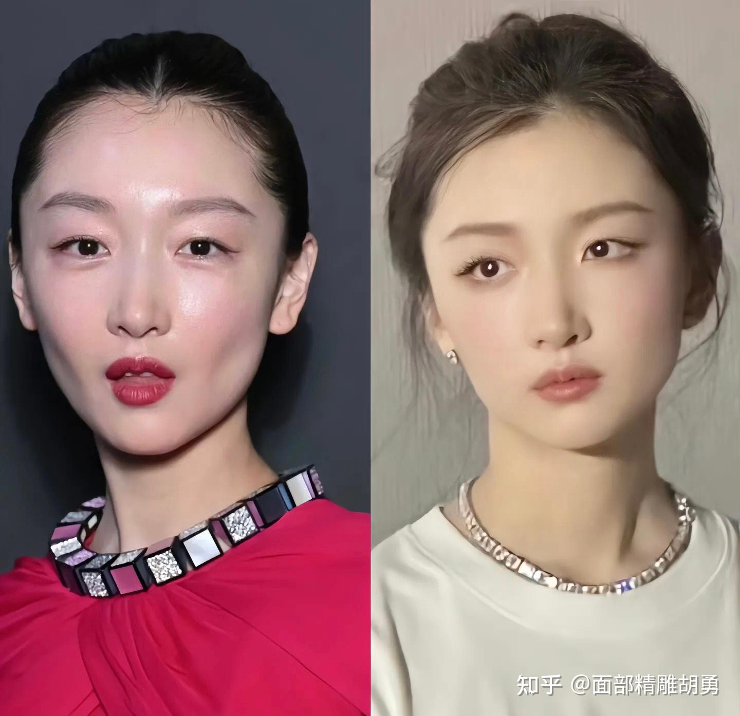面颊填充科普 - 知乎