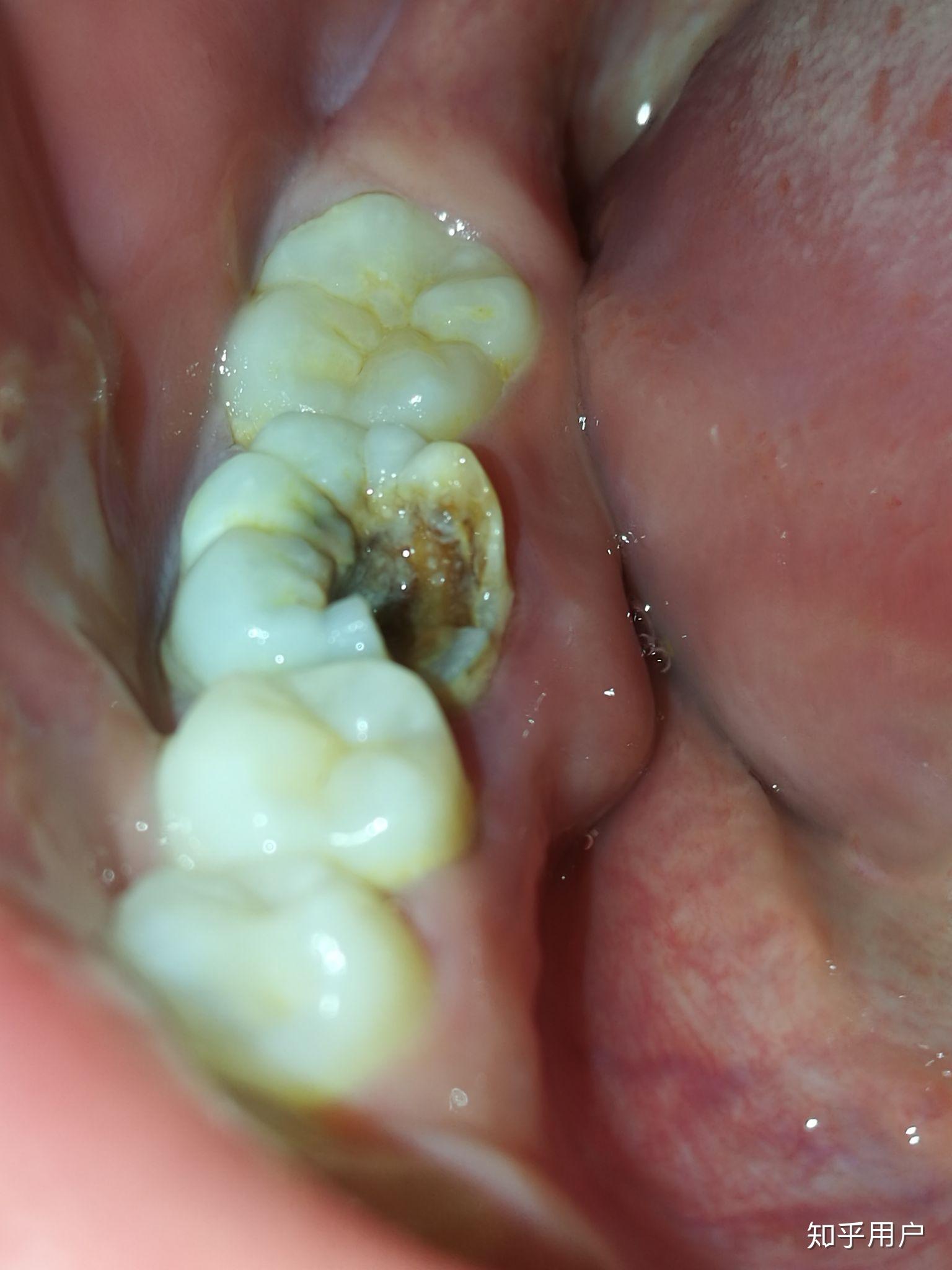 一口龋齿是什么样的体验? - 知乎