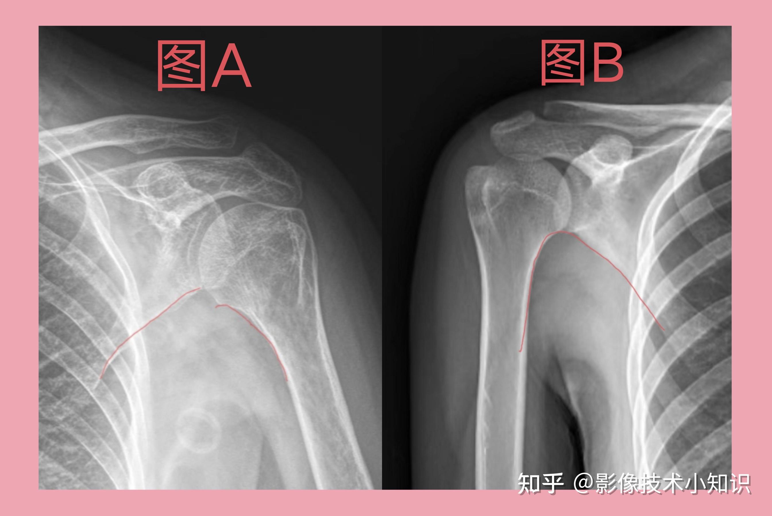 肩关节水平外展图片图片