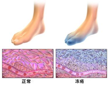 冻疮的预防很重要,冬天你一定要知道这些 - 知乎