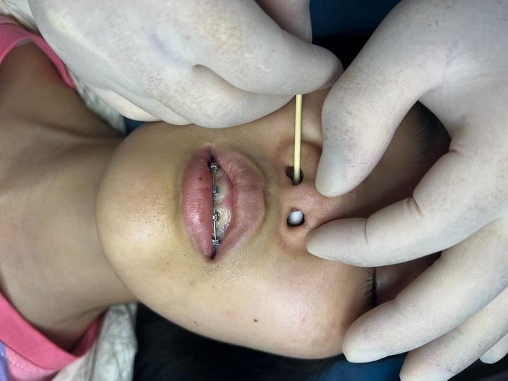 3岁女童鼻孔塞入纽扣电池,取出时鼻中隔腐蚀穿孔,鼻部高难度修复怎么