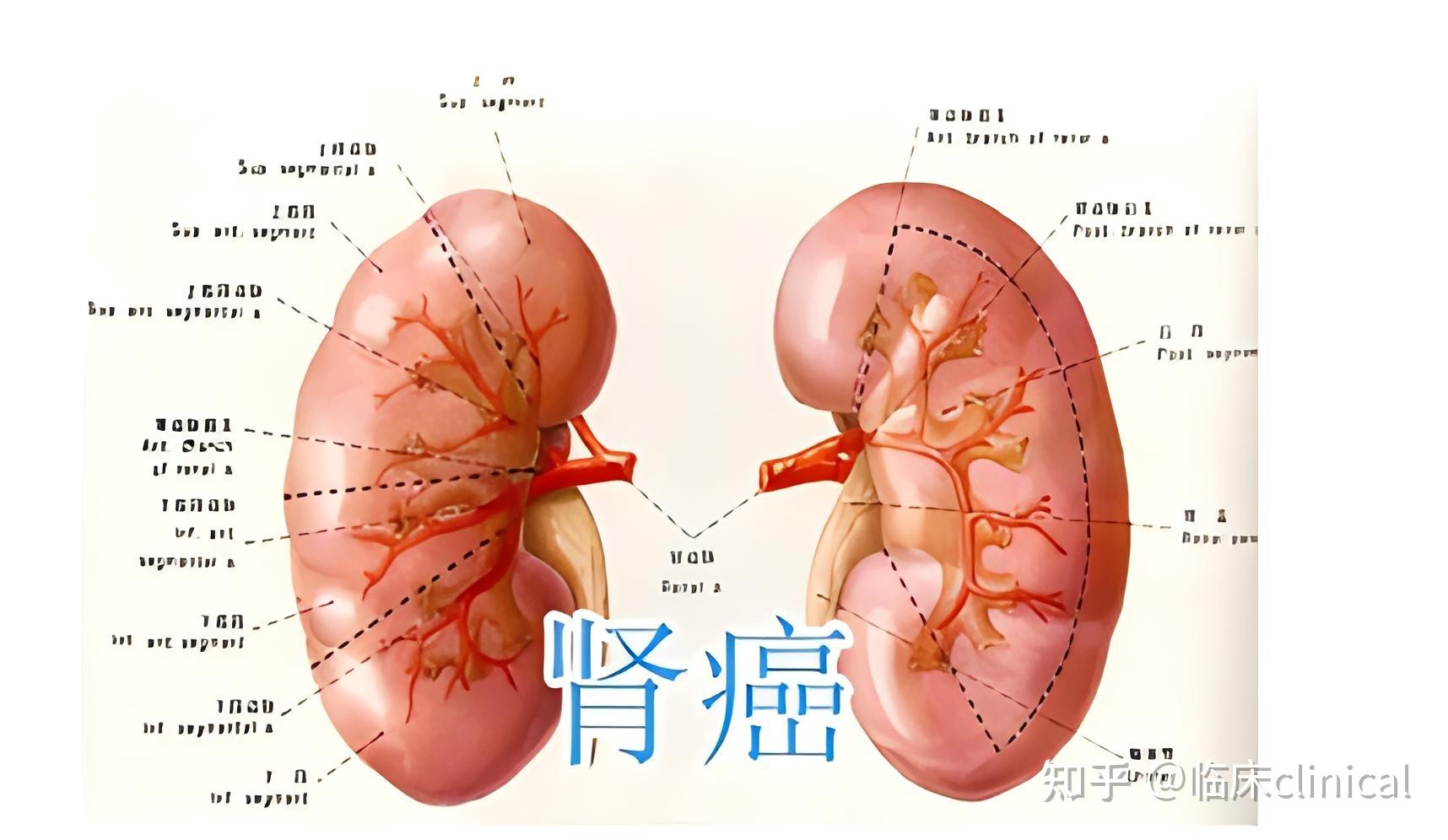 肾癌早期的五个表现图片