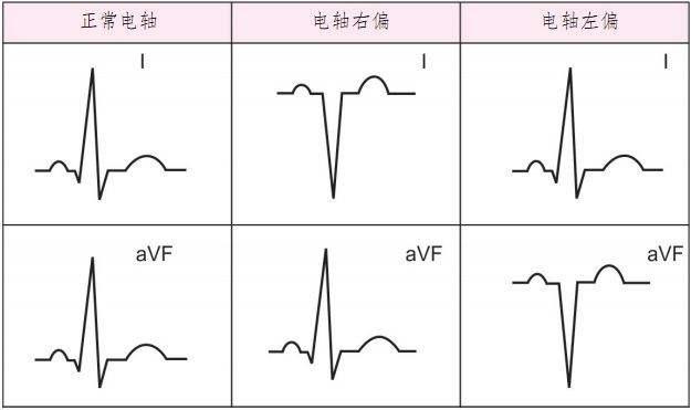 招飞体检常见心电图术语及鉴定:心电轴偏转