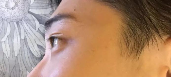 侧面看眼睛非常突,眉骨低和鼻子连接不起来是怎么回事?