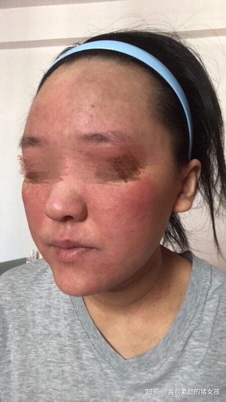 激素依赖性皮炎通常如何治疗?