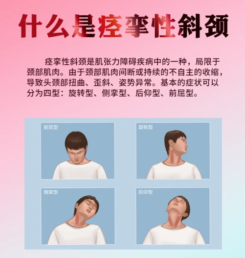 痉挛性斜颈的五个原则,你要知道! - 知乎