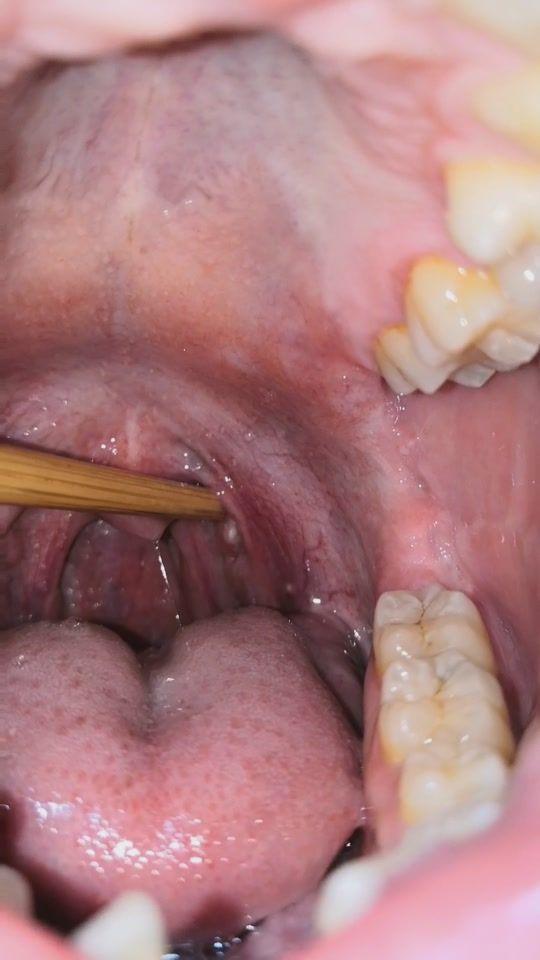 扁桃体结石是如何形成的?