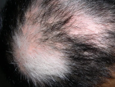 头上有白癜风,怎么连头发都变白了?