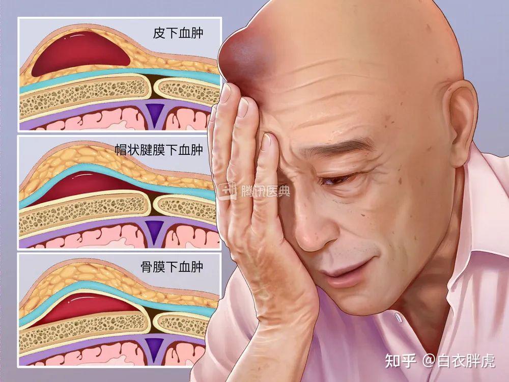 头皮血肿比较大的图片图片