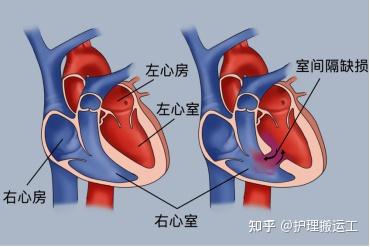 室间隔缺损基础知识 - 知乎