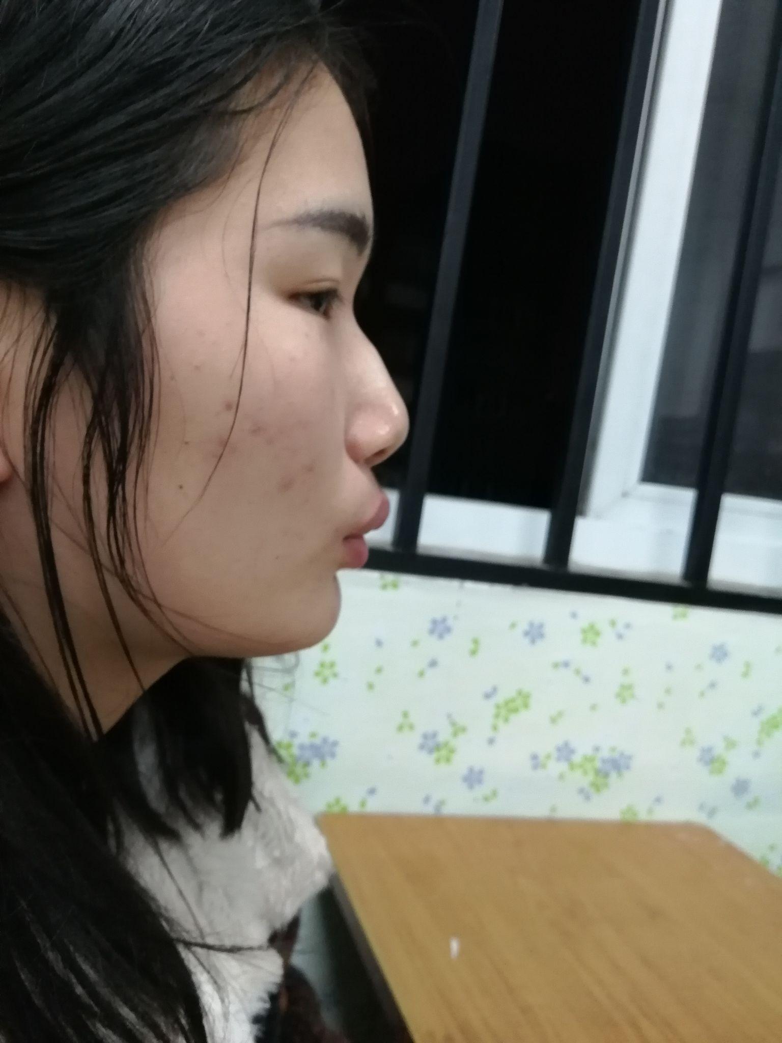 龅牙凸嘴怎么改善侧脸