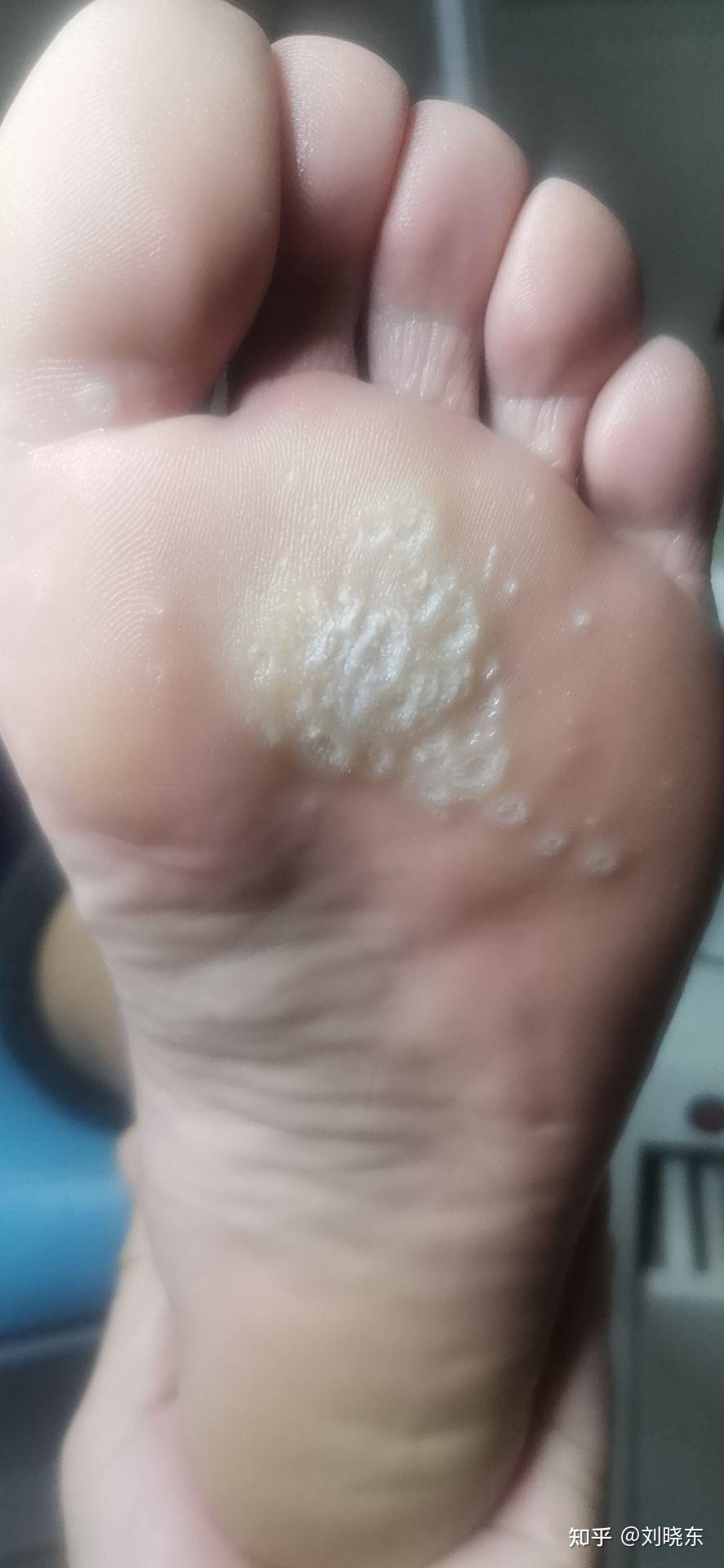 脚底跖疣有去修脚店治疗的吗