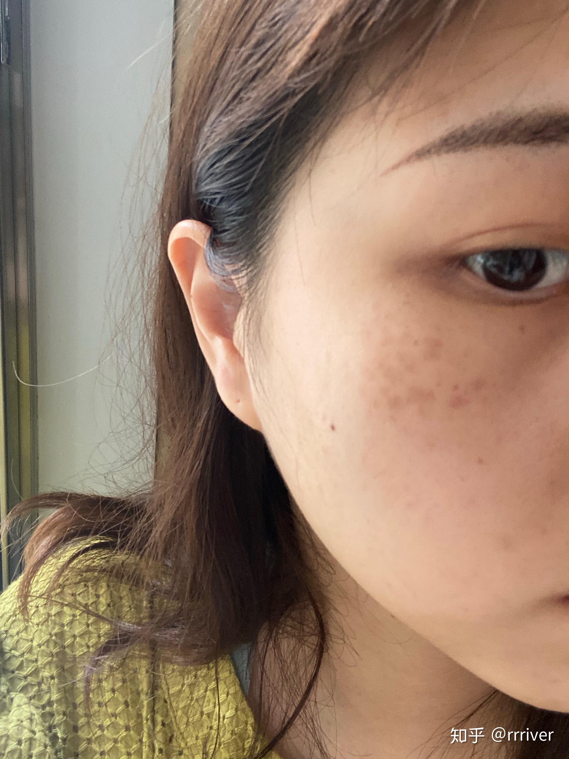 有谁褐青色痣治好过