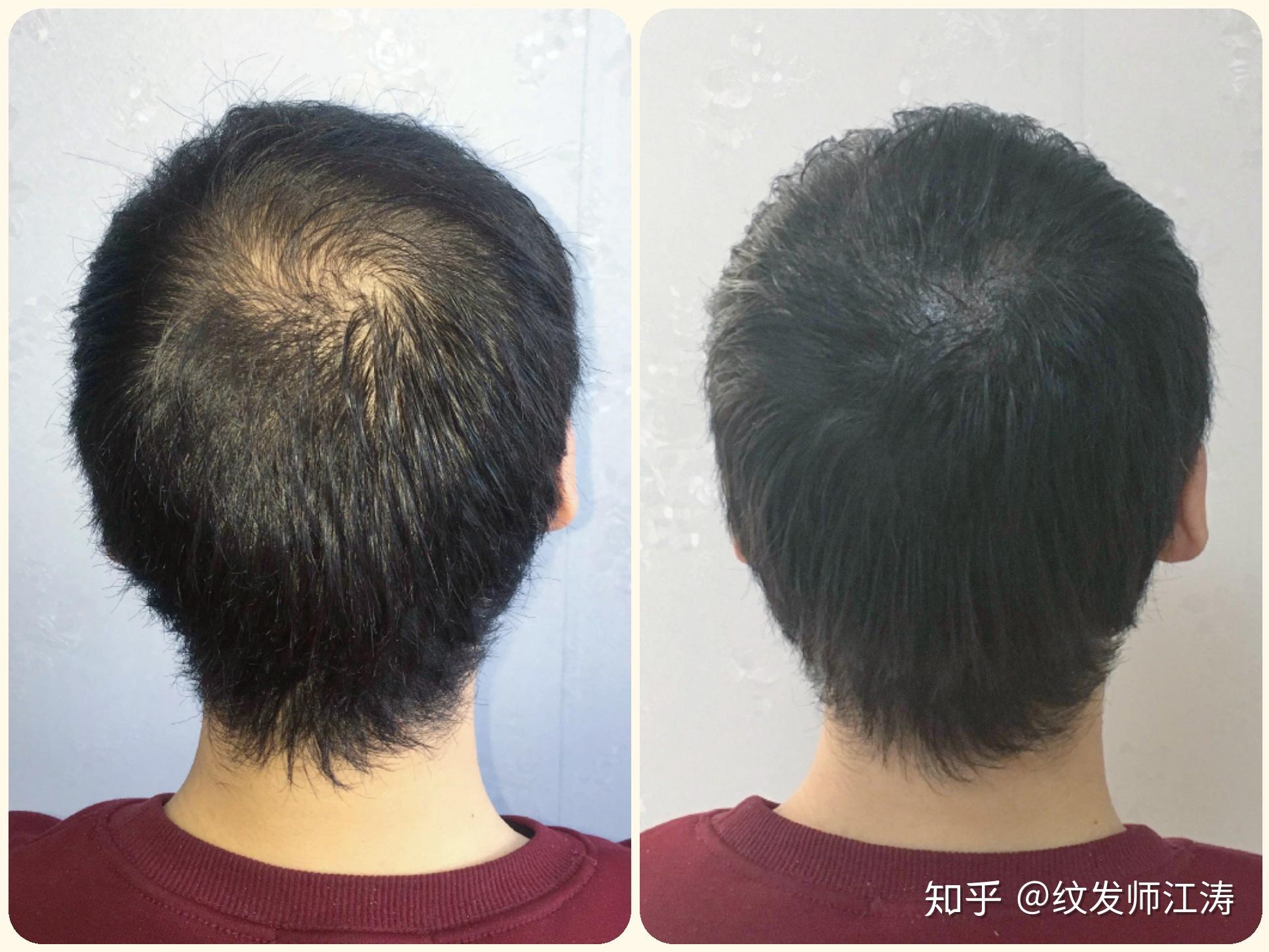 头顶头发少但不脱发怎么办? - 知乎