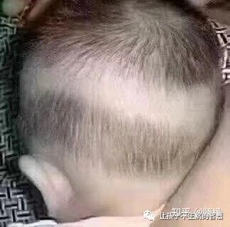 宝宝枕秃是缺钙吗?是枕头磨的吗? - 知乎