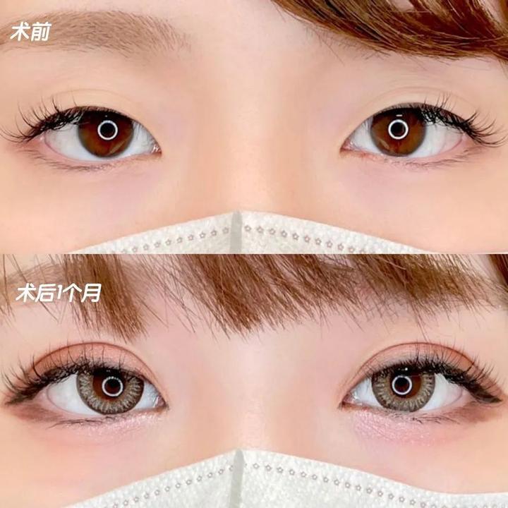 定点双眼皮——打造双眸焦点,散发自信魅力! - 知乎