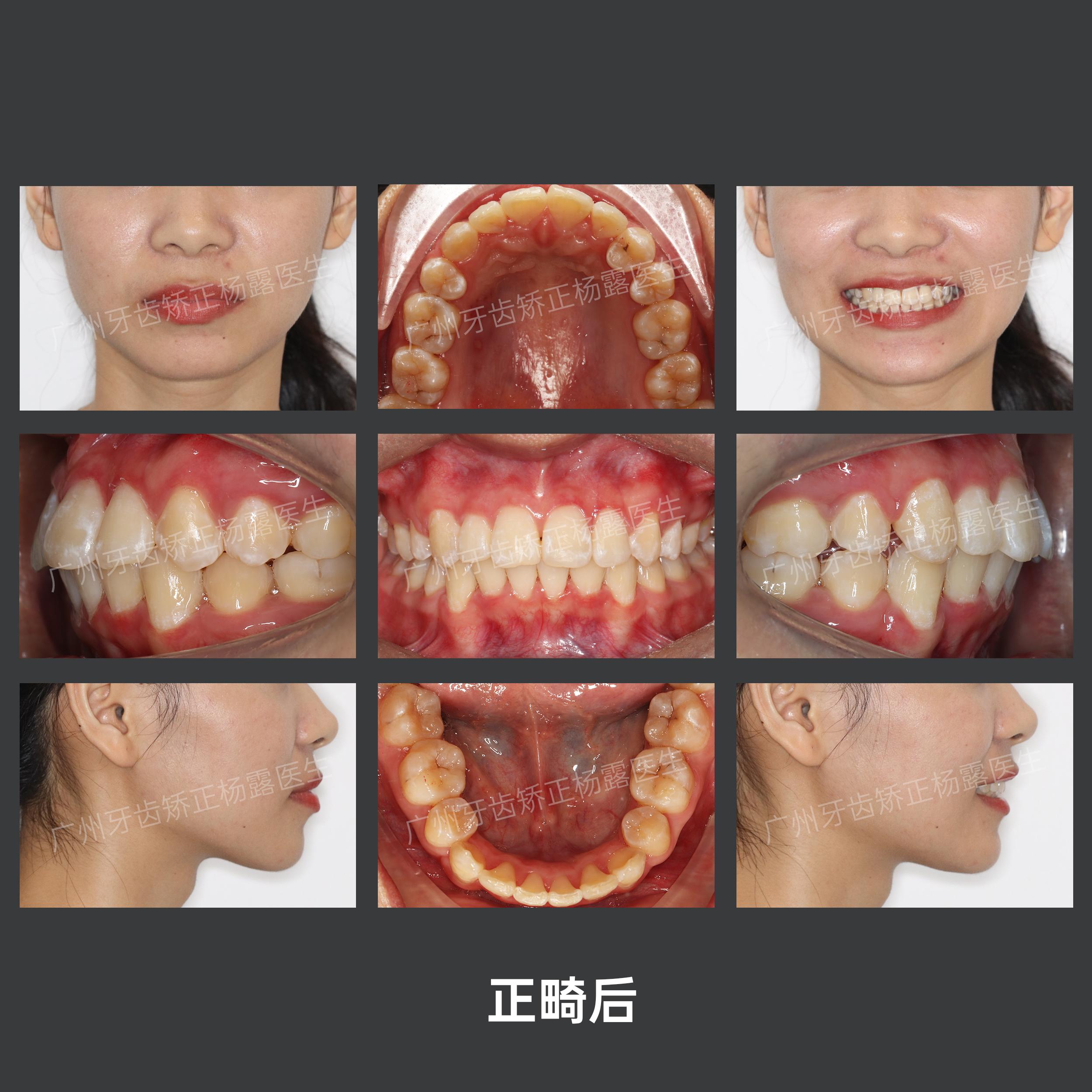 骨性前突,正畸效果如何? - 知乎