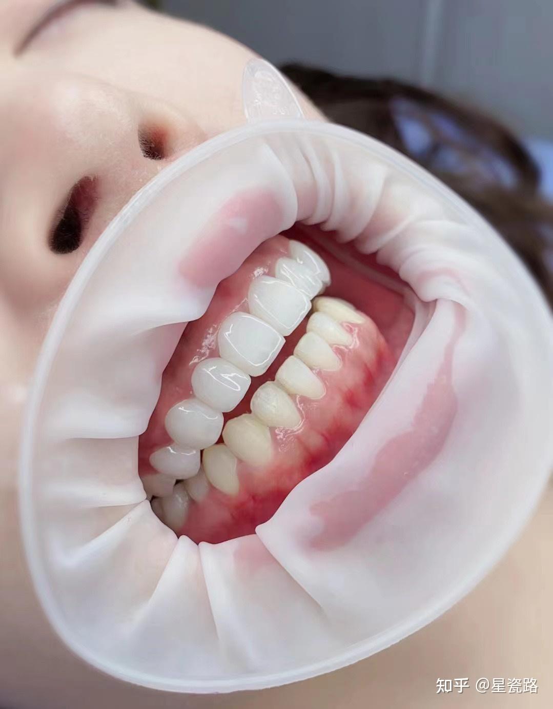 牙贴面是怎么做的过程