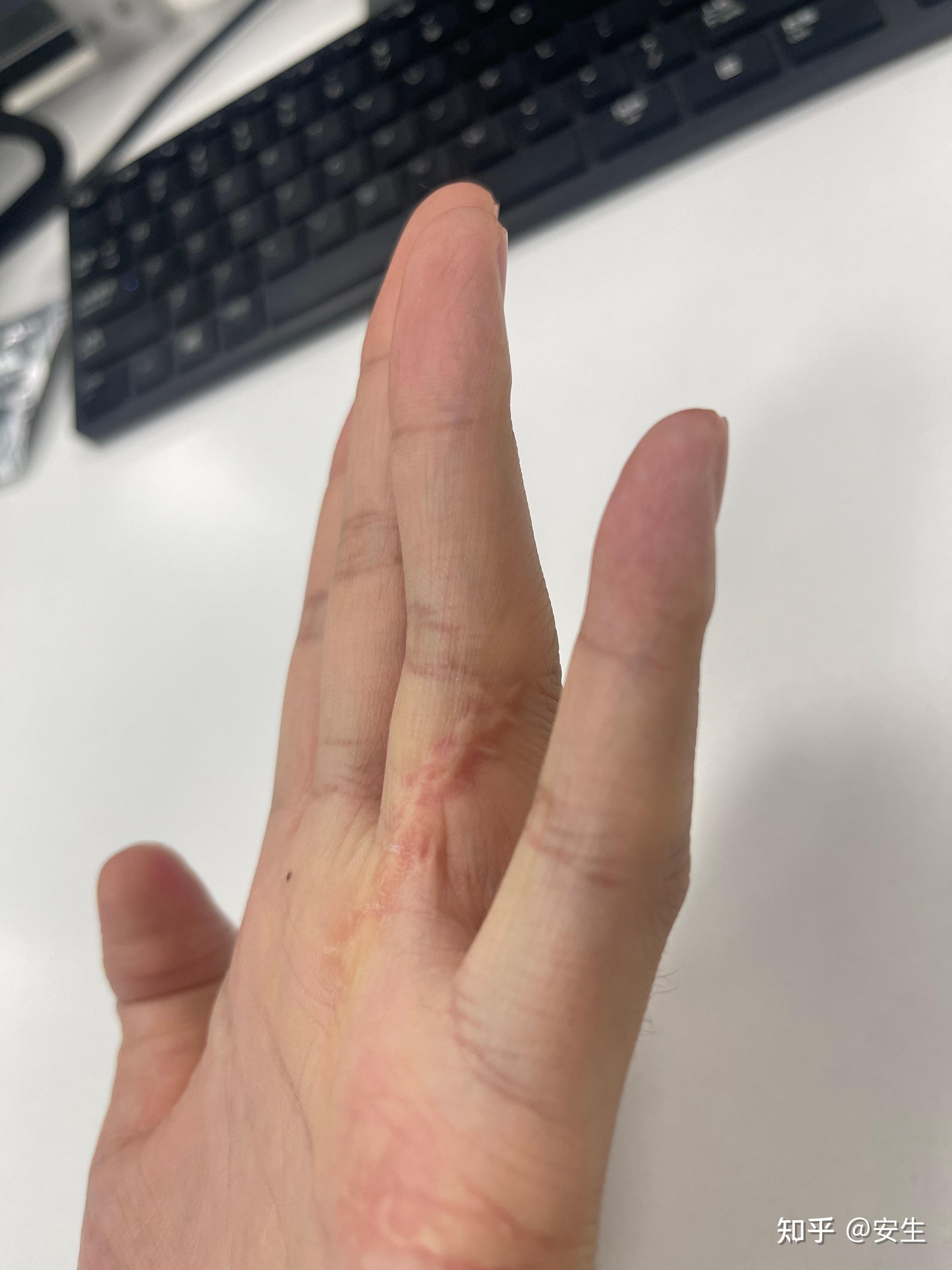 手指肌腱断裂有解无解?