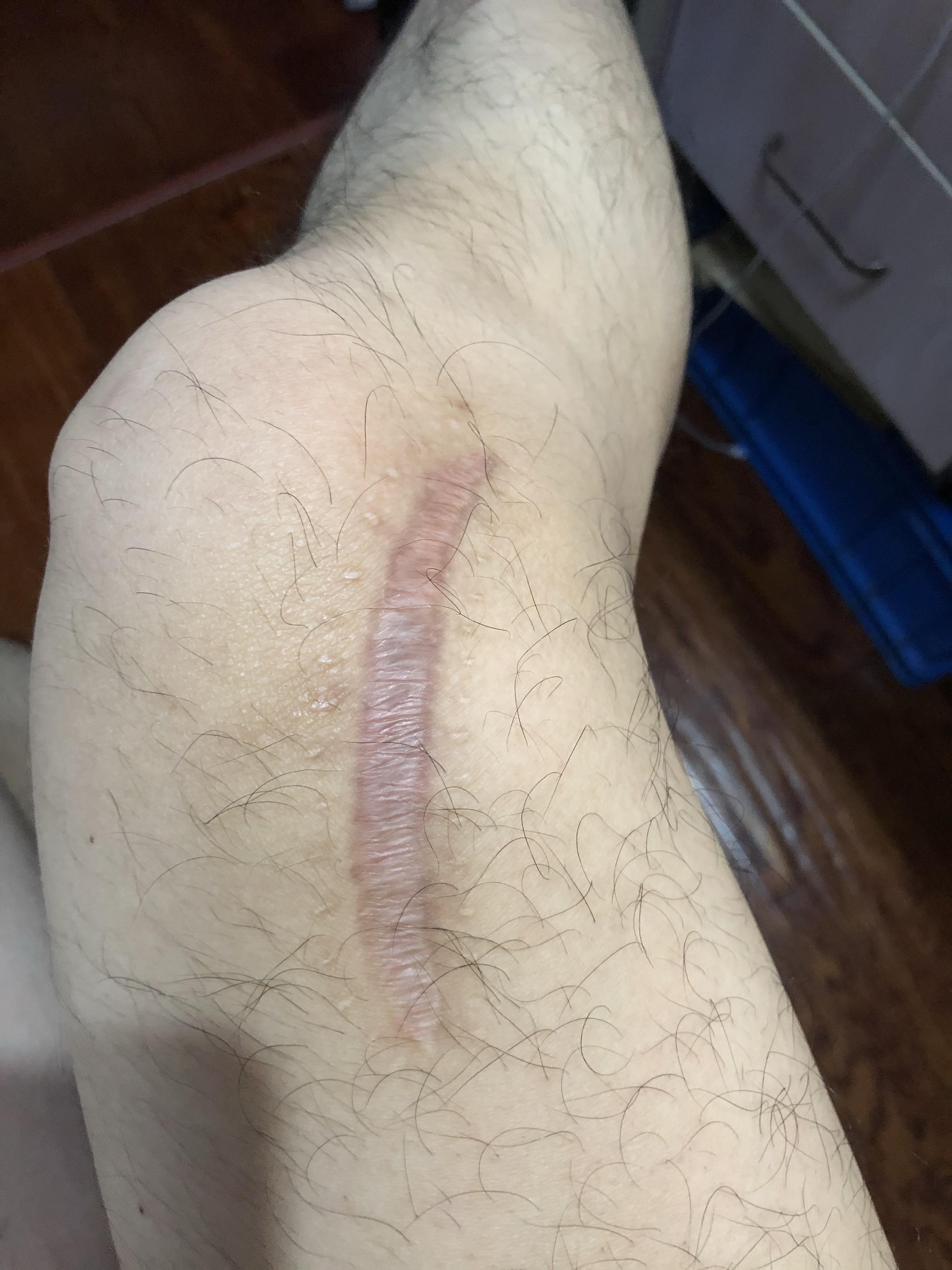 右胫膝盖内侧良性骨软骨瘤对以后有影响吗?不手术切除的话. - 知乎