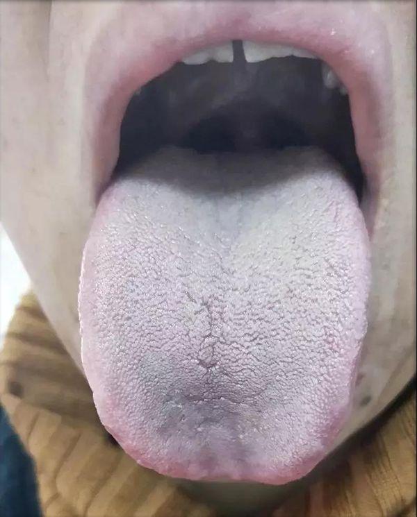 脾胃湿寒的舌头图片如何健脾胃去寒湿