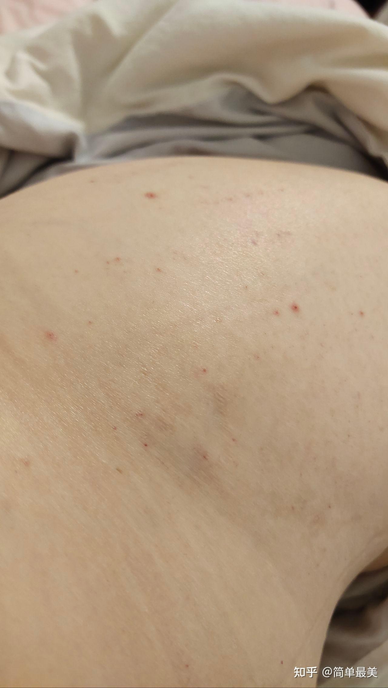 这个皮肤上痒痒的红点不会是艾滋病吧