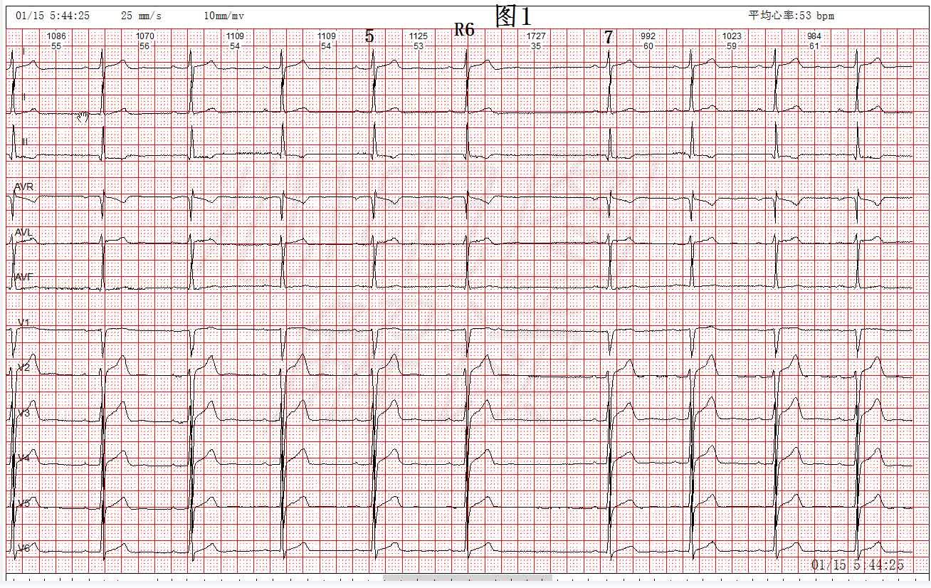 心脏漏搏的心电图图片