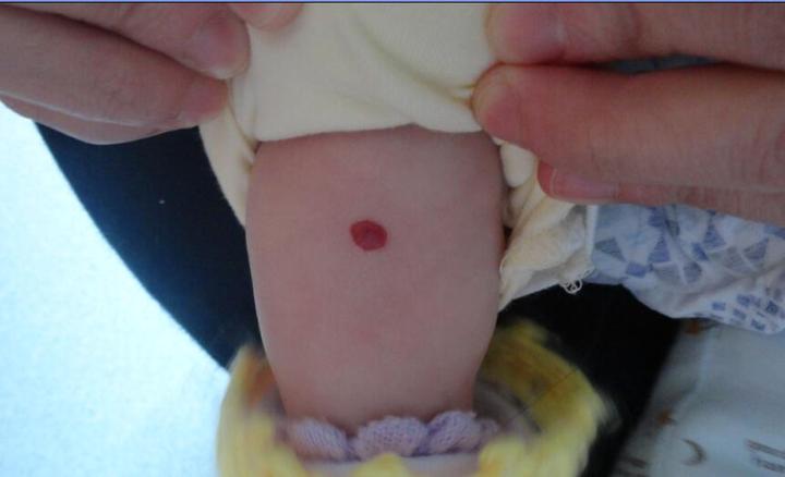 静脉血管瘤的有什么临床表现