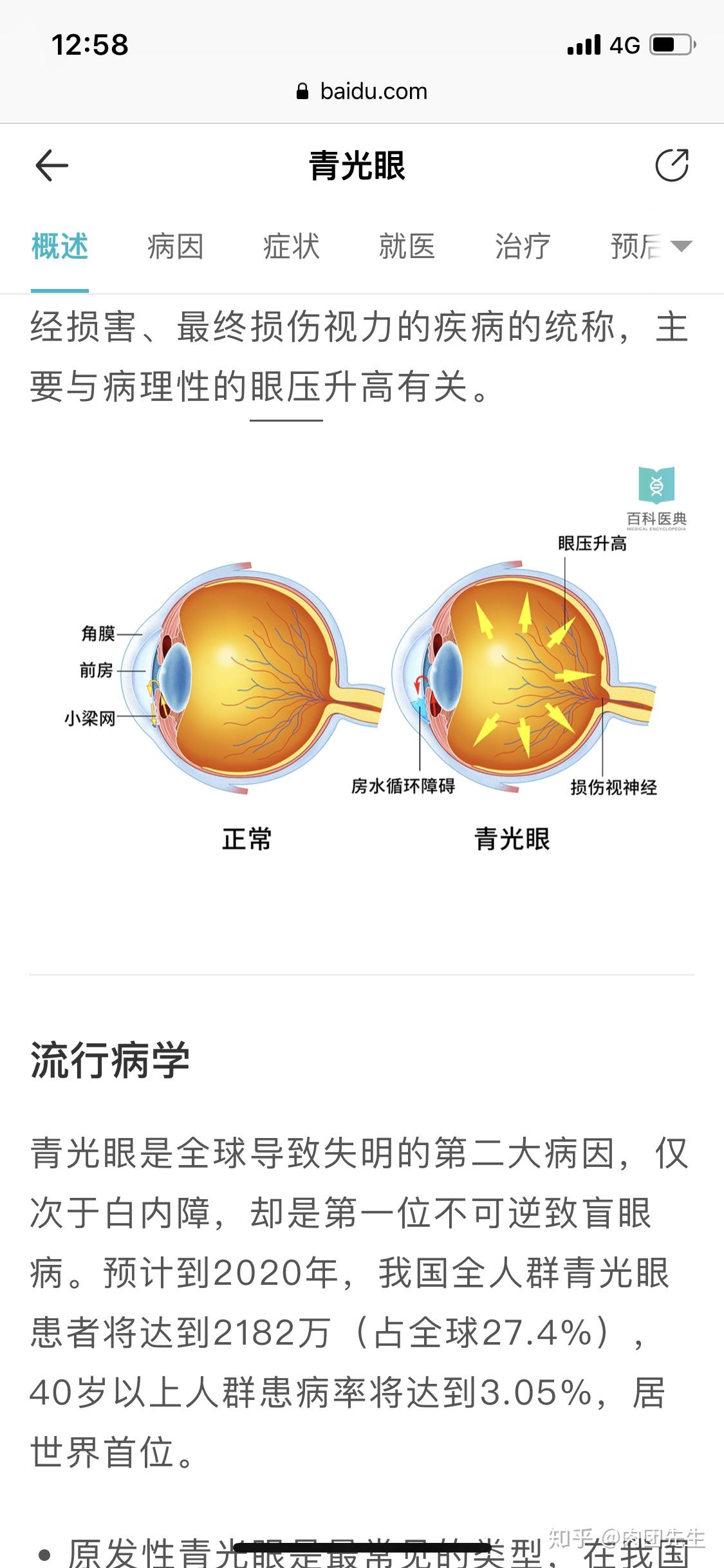 怀疑自己有青光眼是种什么样的体验? - 知乎