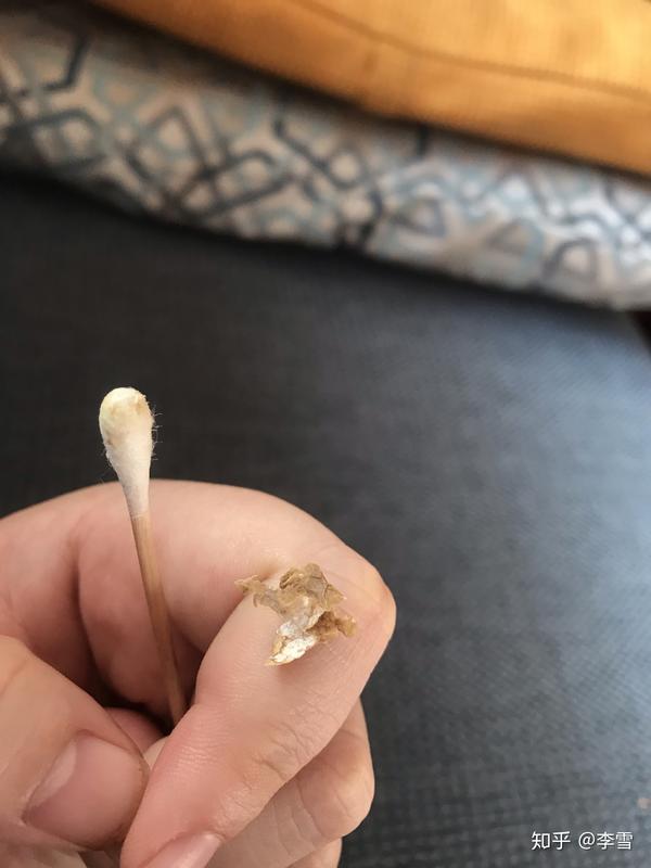 耳屎能大到什么程度?