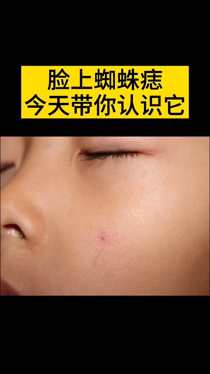 人康皮肤科普皮肤上的蜘蛛痣到底是什么