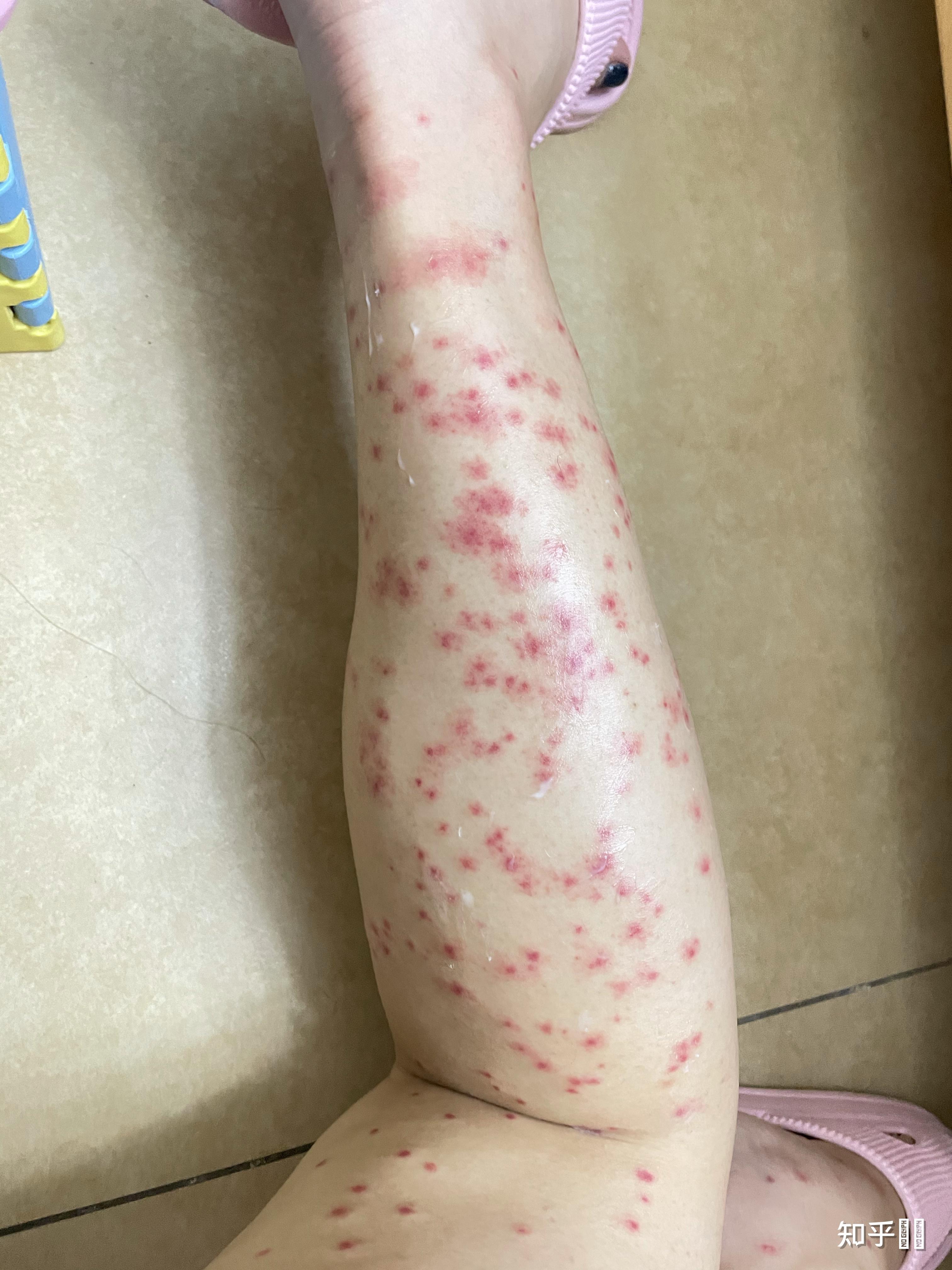 你被蚊子咬到最惨痛的一次经历是什么? - 知乎