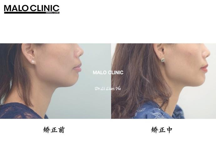 北京牙齿矫正丨嘴突、闭唇紧张、深覆合,隐适美推磨牙向后 - 知乎