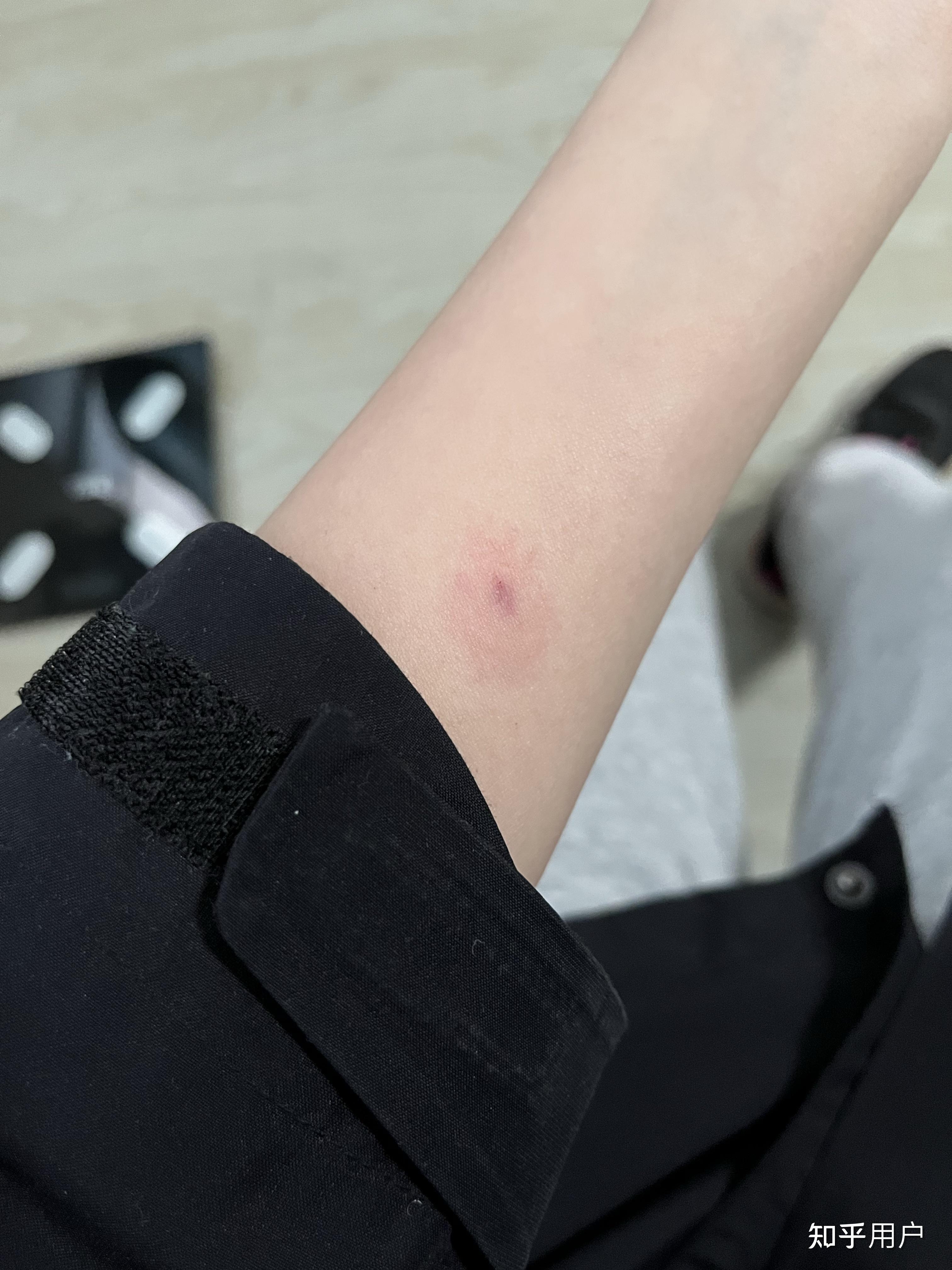 ppd皮试后这个样子怎么办? - 知乎