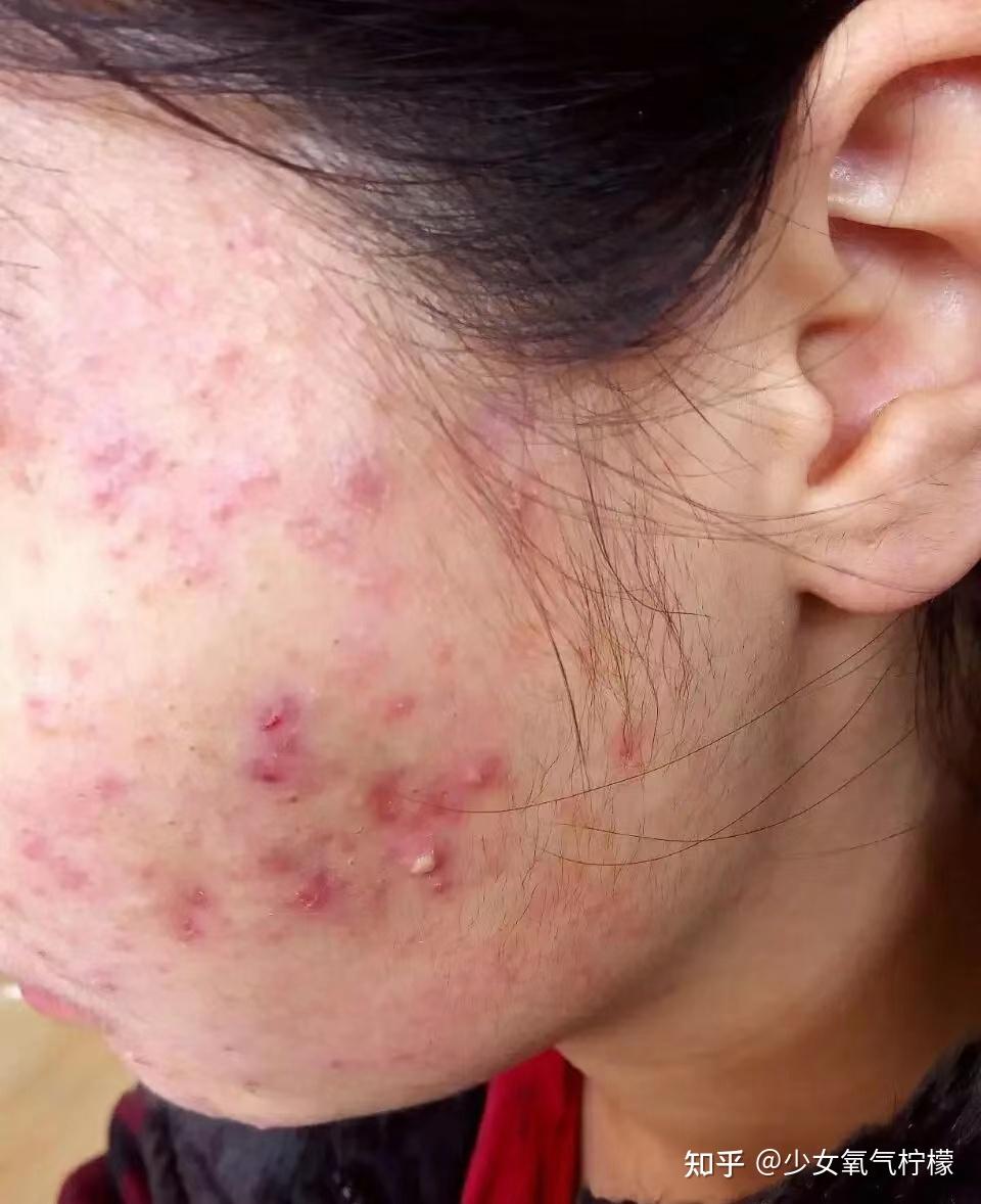 皮肤敏感一化妆就长痘而且痘痘不断应该怎么办