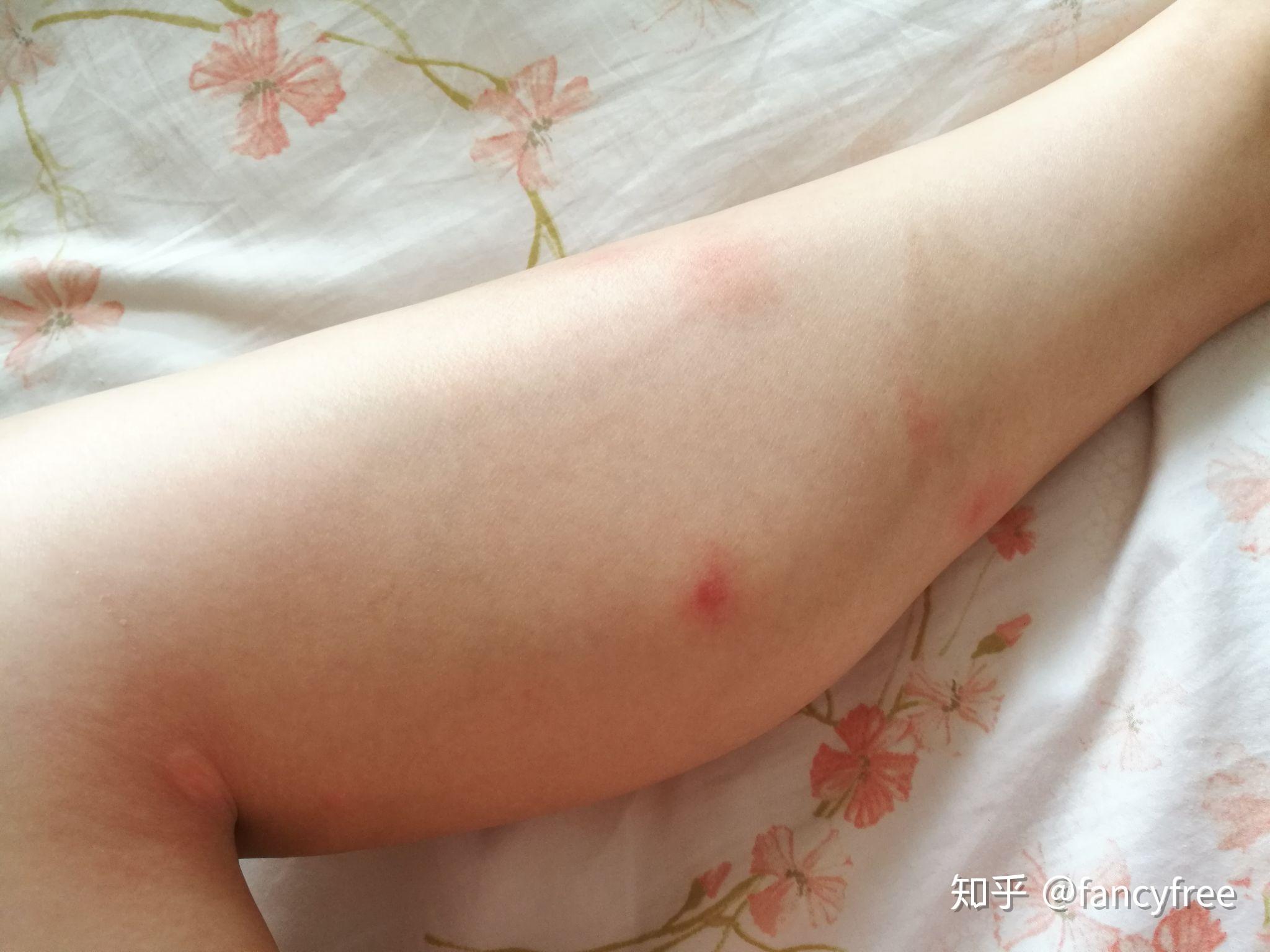 被蚊子咬后身上起一又红又大的包,请问抹什么才能止痒消包?