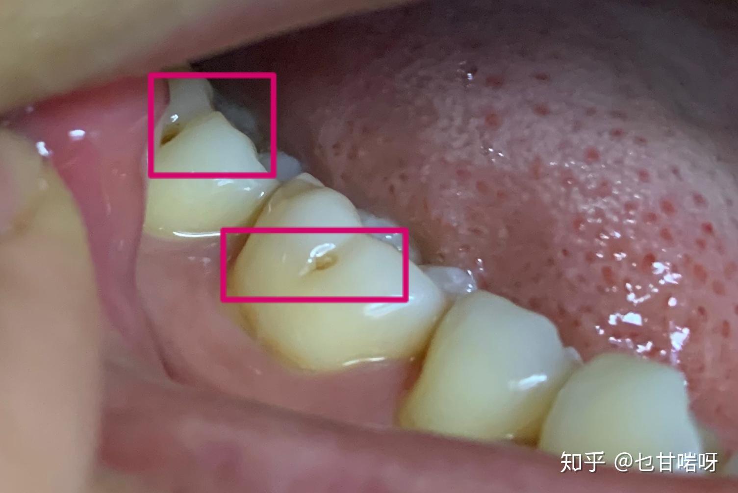 智齿发炎怎么缓解? - 知乎