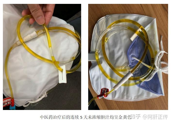 胆汁成分与功能,胆囊形态与结构综述 - 知乎